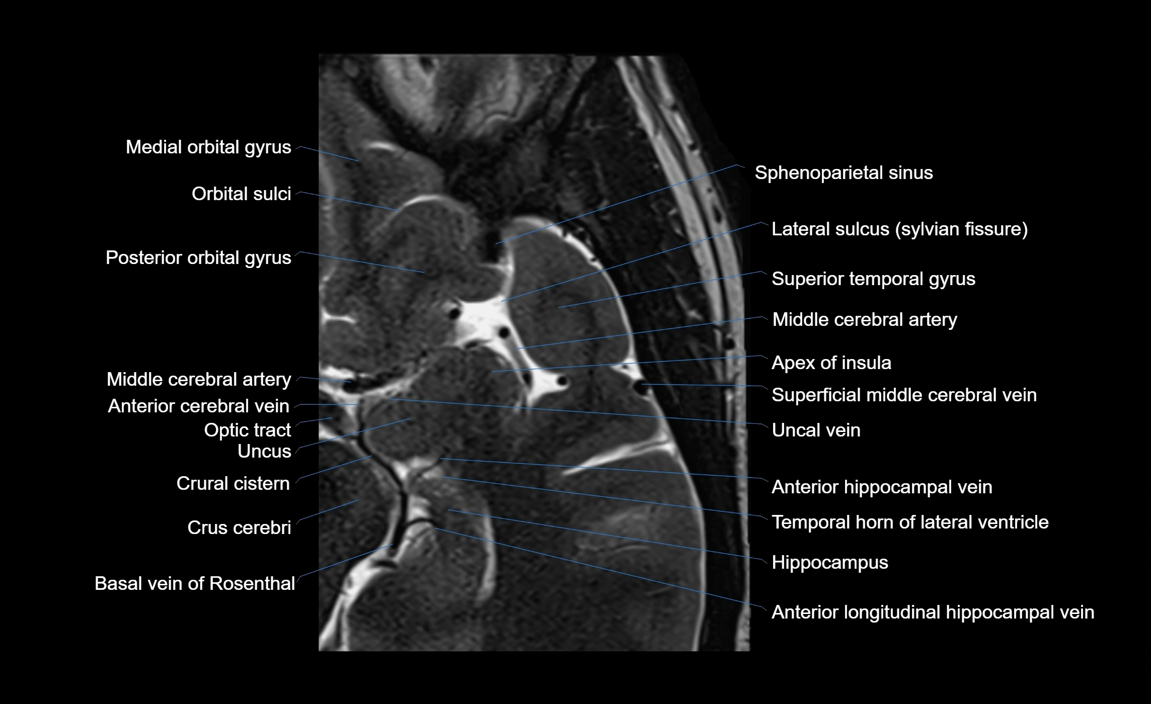 Brain insula axial  anatomy 3T MRI image-img-00001-00003.webp